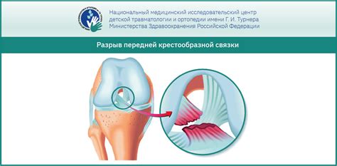 Повреждения и травмы коленного сустава