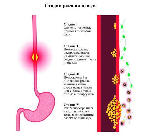 Повреждения слизистой оболочки пищевода