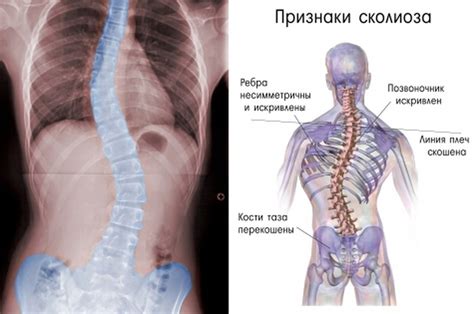 Повышение риска сколиоза