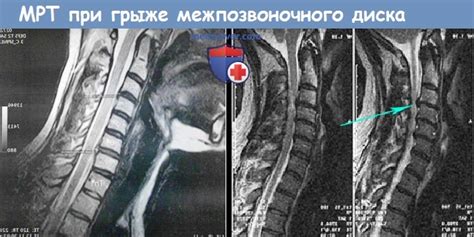 Повышенный риск развития шейного синдрома