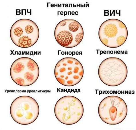 Половые болезни и безопасный секс