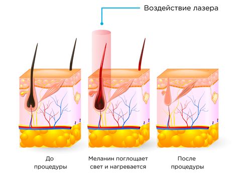 Последствия пилинга и лазерной эпиляции