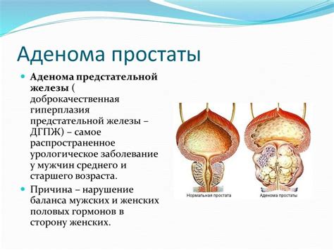 Постепенное увеличение предстательной железы у мужчин: причины и последствия