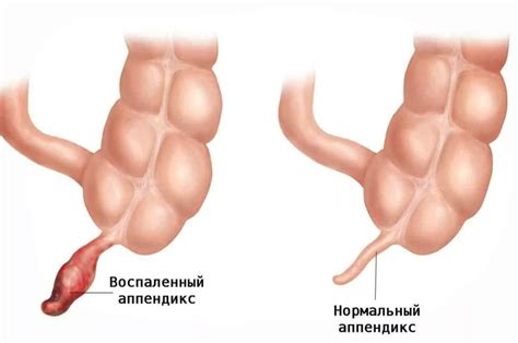 Почему возникает воспаление аппендикса у женщин после 50?