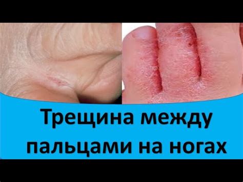 Почему возникает шелушение и трещины между пальцами на ногах?