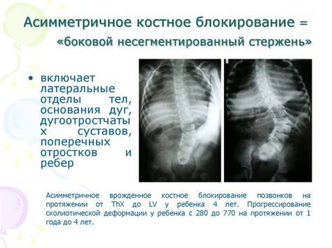 Предотвращение неправильного развития позвоночника