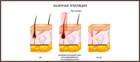 Принцип работы лазерной эпиляции