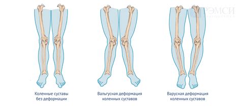 Причины заваливания ног внутрь на роликах