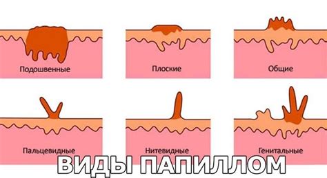 Причины самовыпадения папилломы