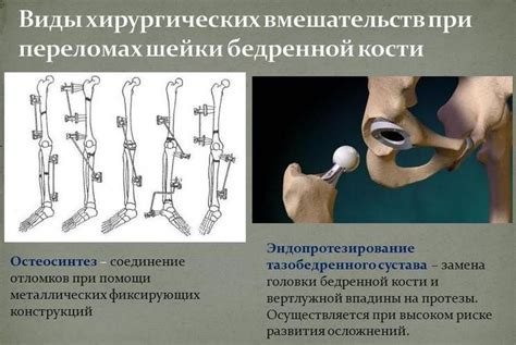 Прокол шейки бедра