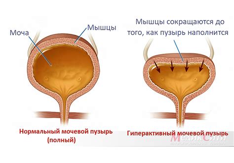 Психоэмоциональные факторы и их влияние на давление на мочевой пузырь