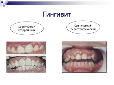 Развитие пародонтита и гингивита: связь между употреблением соды лав и заболеваниями пародонта