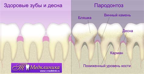 Раздражение десен и зубов