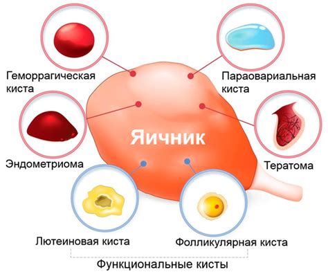 Размеры кисты яичника