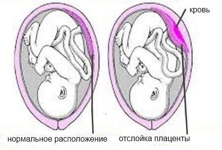 Разные плаценты