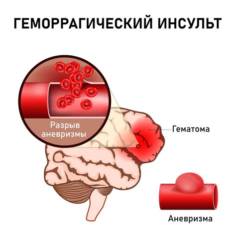 Разрыв кровеносных сосудов