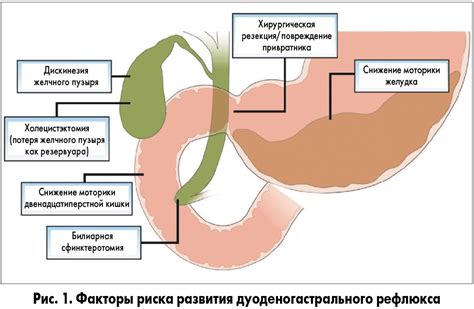 Рефлюкс дуодено-гастроэзофагеальный