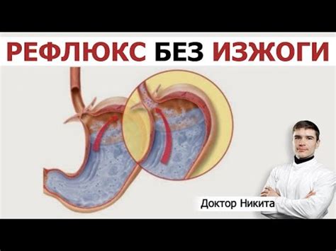 Рефлюкс кислоты из желудка в пищевод как причина тошноты и излишнего слюноотделения