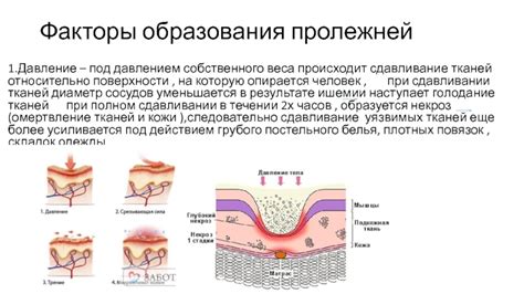 Сдавливание тканей