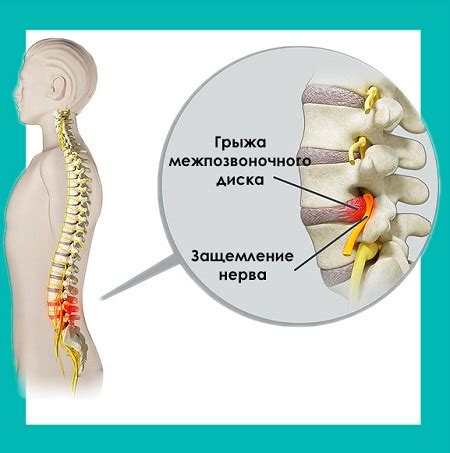 Симптомы корешкового защемления нерва в пояснице