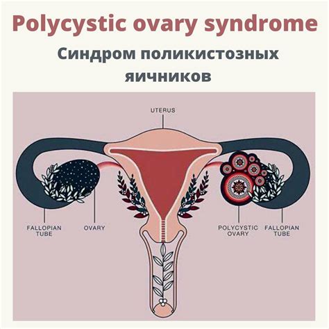 Синдром поликистозных яичников и его связь с ростом фолликулов