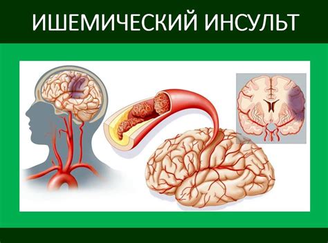 Сосудистые нарушения: ишемический инсульт