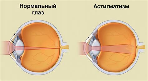 Способы лечения глазодвигательных нарушений