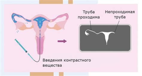 Способы предотвращения сращивания маточных труб