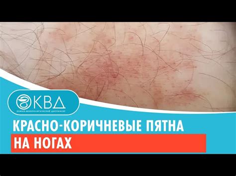 Способы устранения коричневых пятен на коленях