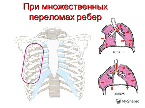 Травма ребер или груди