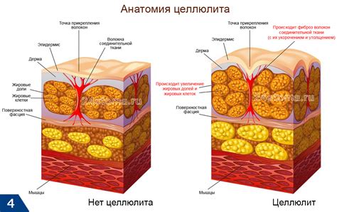 Травмирование жировых клеток