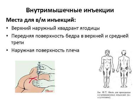 Три основные причины делать инъекции в верхний квадрант ягодицы