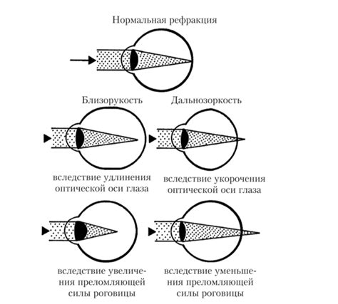 Ускоряет адаптацию к измененной зрительной рефракции