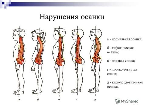 Ухудшение осанки и выведение позвоночника из положения равновесия