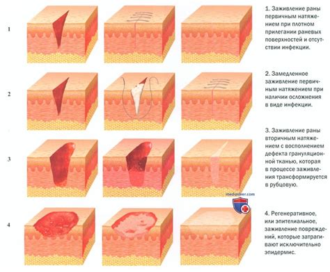 Ухудшение процесса заживления ран