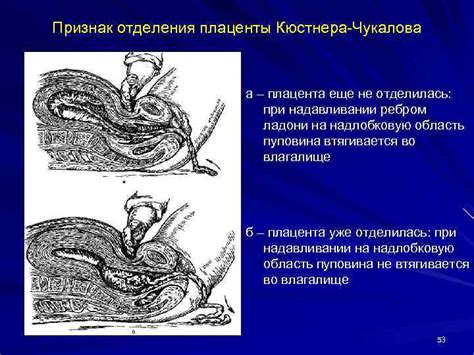 Физиологический процесс отделения плаценты