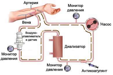 Частота проведения гемодиализа