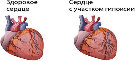 Что такое гипоксия