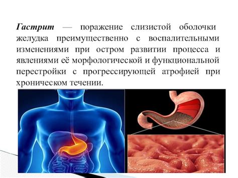 Язвенное поражение слизистой оболочки желудка