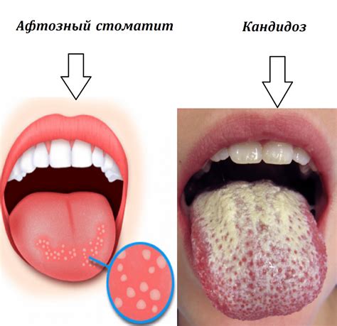  Анемия и возможное появление жжения языка и горечи во рту 